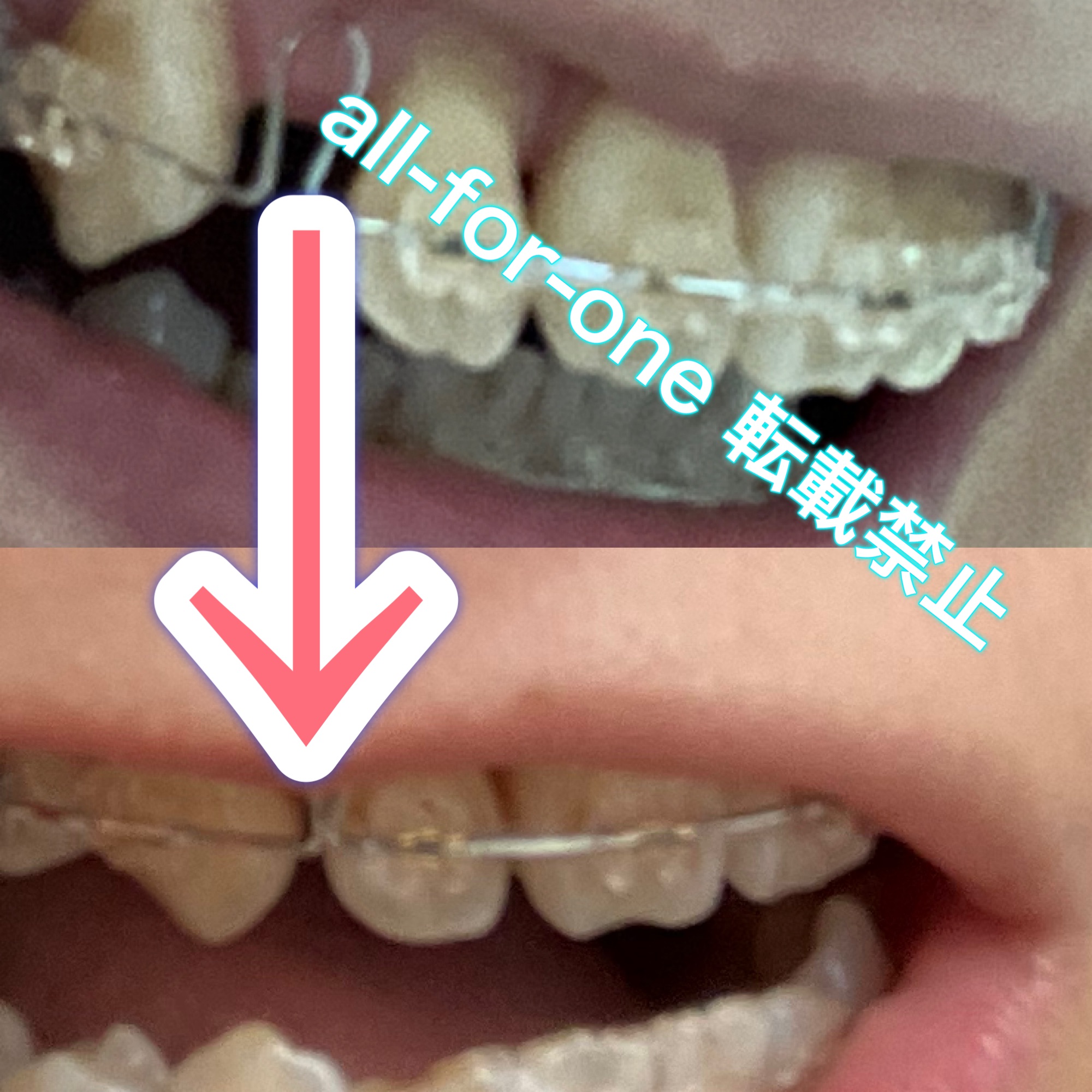 歯列矯正のための抜歯後スペースが変化する様子