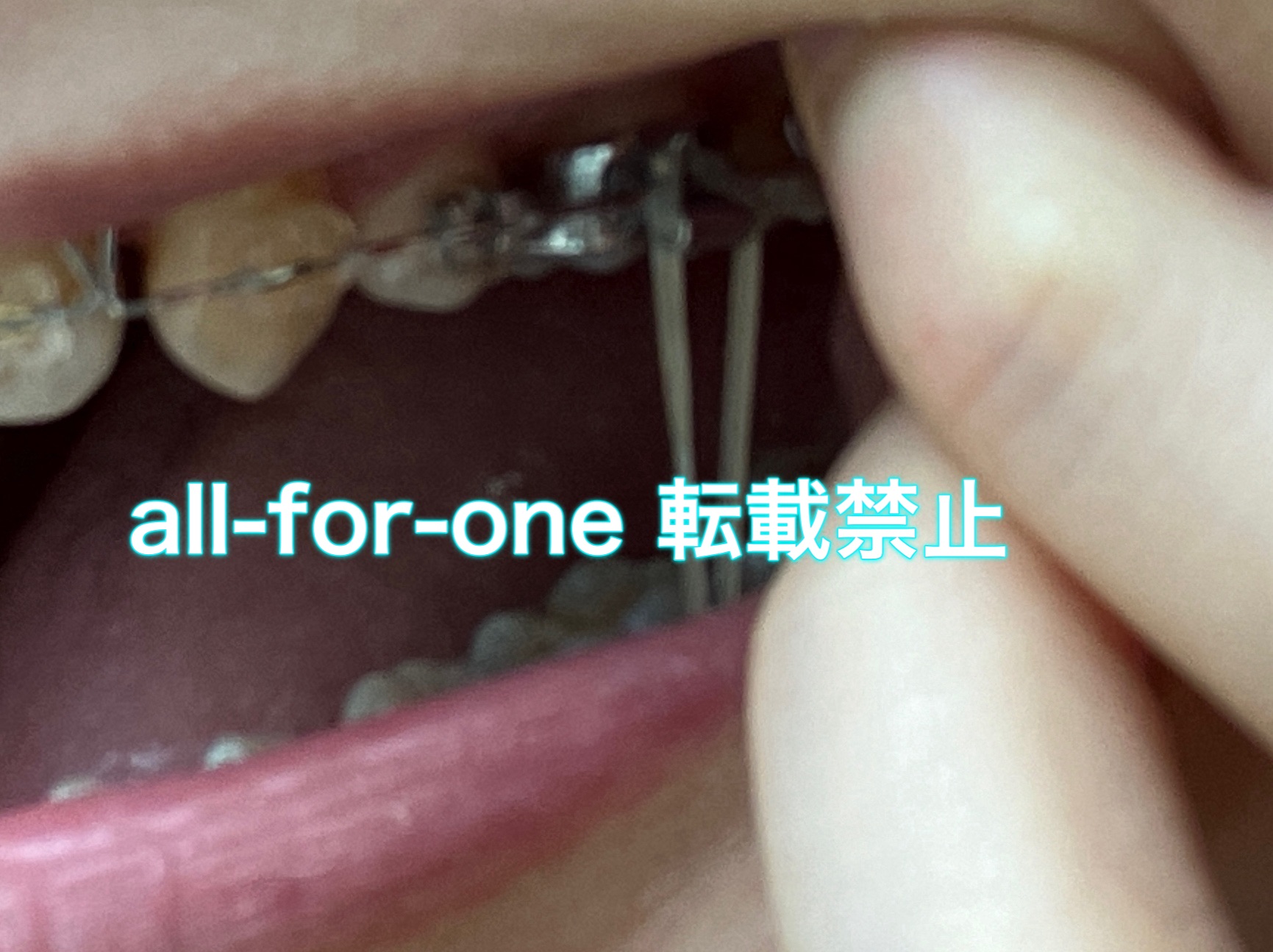 歯列矯正中のゴムかけの様子